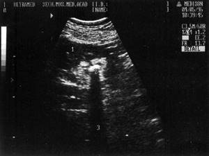 Ultrasound picture of a kidney with a stone in the pelvis: 1-kidney, 2-stone, 3-acoustic shadow