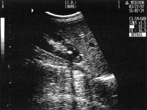 Ultrasound picture of a kidney with a calculus in the neck of the calyx with symptoms of its obstruction and hydrocalycosis (arrow)