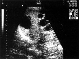 Sonographic picture of polycystic liver disease
