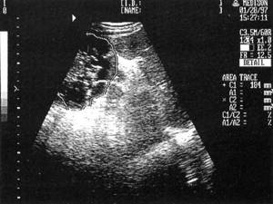Sonographic picture of polycystic kidney disease (the left kidney is circled with the cursor)