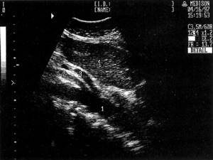 Sonographic picture of the longitudinal section of the aorta (1), superior mesenteric (2) and celiac (3) arteries