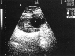 Sonographic picture of a simple uncomplicated cyst (K) of the left kidney