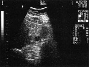 Sonographic picture of a simple salitary cyst of the right lobe of the liver (marked with markers)