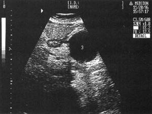 Sonographic picture of a pancreatic pseudocyst: 1-liver, 2-stomach, 3-cyst