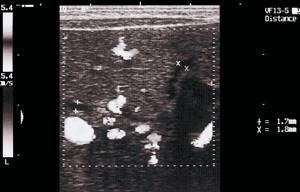Sonographic picture of Caroli syndrome: Dopplerography of the liver in Caroli syndrome (blood flow in the veins is visible), at the same time unevenly dilated bile ducts are visualized (blood flow inside is not determined), highlighted with markers