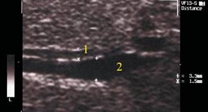 Эхографическая картина синдрома Кароли: эхографическое изображение неравномерно расширенного внутрипеченого протока (2) рядом с веной (1), стенки вены более плотные