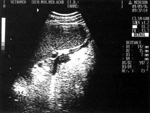 Sonographic picture of an enlarged spleen (1) due to cirrhosis of the liver, dilated splenic (2) and gastric (3) veins