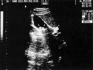 Sonographic picture of cholelithiasis (two “soft” cholesterol stones are marked with arrows)