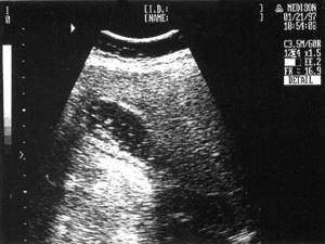 Sonographic picture of cholelithiasis - multiple small floating stones in the cavity of the gallbladder