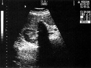 Sonographic picture of cholelithiasis - disabled gallbladder