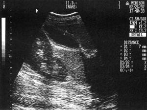 Sonographic picture of the gallbladder during exacerbation of chronic cholecystitis (thickening and layering of the wall)