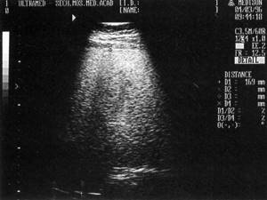 Sonographic picture of fatty infiltration of the liver - increased echogenicity of the parenchyma with a weakening effect in the deep parts of the liver