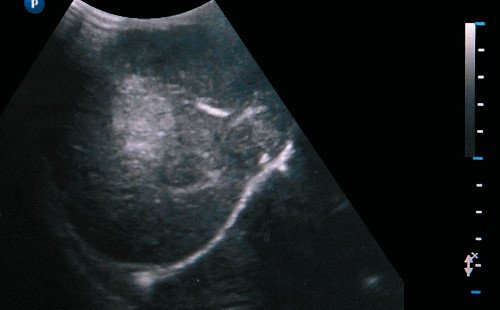 Sonographic image of a liver tumor (arrow)