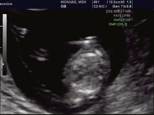 Echogram - 4-chamber section of the fetal heart, the chambers of the heart are clearly visible, pregnancy 12 weeks