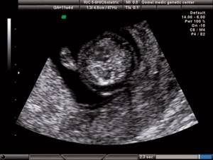 Echogram - 4-chamber section of the heart, a single atrioventricular valve, there is no cross of the normal relationship between the atrioventricular valves and the cardiac septa, pregnancy 11.4 weeks