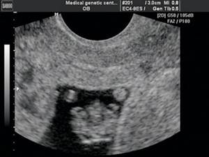 Echogram - ectopia of the heart, the heart is located outside the chest cavity, pregnancy 8 weeks (a)