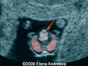 Echogram - ectopia of the heart, the heart is located outside the chest cavity, pregnancy 8 weeks (b)