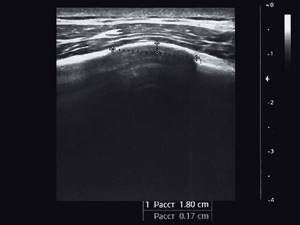 Echogram - callus 24 months after the fracture, longitudinal projection