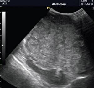 Echogram of a liver tumor in normal mode