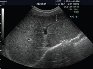 Echogram of the liver of a 12-year-old teenager in normal mode