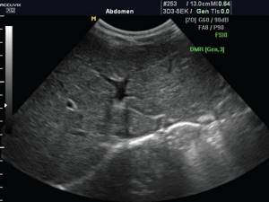 Echogram of the liver of a 12-year-old teenager in MRI mode