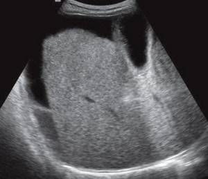 Echogram of the liver with cirrhosis