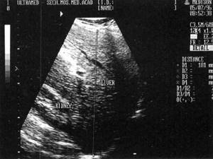 Echogram of the right lobe of the liver with its enlargement: Liver-liver, Kidney-kidney