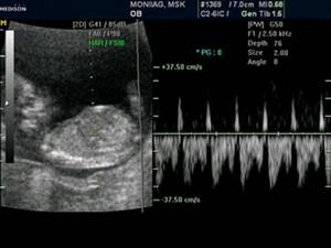 Echogram - reverse blood flow in the venous duct in a fetus with heterotaxy, 12 weeks&#39; pregnancy