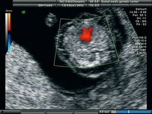 Echogram (CDC mode) - 4-chamber section of the heart, single atrioventricular valve, pregnancy 11.4 weeks