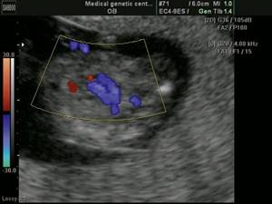 Echogram (CDC mode) - double exit of vessels from the right ventricle, parallel exit of vessels from the right ventricle, pregnancy 13 weeks
