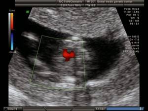 Echogram (CDC mode) - extensive VSD in a fetus with Edwards syndrome (trisomy 18), pregnancy 12 weeks