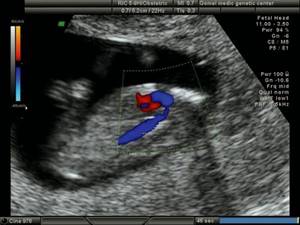 Эхограмма (режим ЦДК) - срез через дугу аорты, сужение аорты в типичном месте у плода с синдромом Тернера (45Х), беременность 12 недель