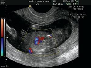 Echogram (CDC mode) - tetralogy of Fallot, section through the outflow tract of the left ventricle, the equestrian aorta is visible, sitting above the VSD, pregnancy 12 weeks