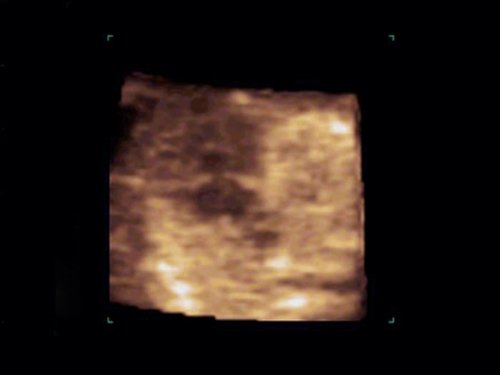 Echogram (STIC mode) - atrioventricular communication (AVC) in Down syndrome, 12 weeks pregnancy