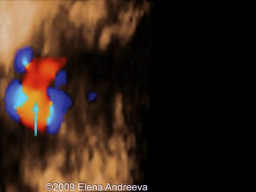 Echogram (STIC mode) - Tetralogy of Fallot, equestrian aorta, sitting above the VSD, 12 weeks pregnancy