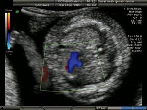 Echogram - hypoplastic left heart syndrome in a fetus with Turner syndrome (45X), single flow through the tricuspid valve, discharge of blood into the hypoplastic left ventricle through the VSD, pregnancy 13 weeks