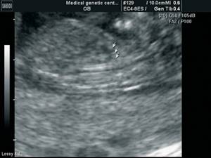 Эхограмма - срез сердца плода через дугу аорты, отчетливо видны три плечеголовных сосуда, отходящих от дуги, беременность 13 недель