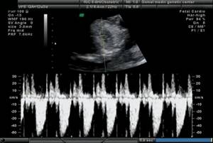 Echogram - tricuspid regurgitation in a fetus with a common truncus arteriosus, pregnancy 12 weeks
