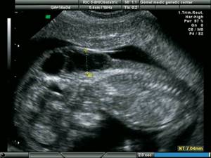 Echogram - increased TVP in a fetus with hypoplasia of the left heart, gestation 13 weeks