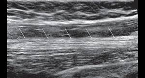 Echogram (B-mode) of the left sciatic nerve in the longitudinal scanning plane in the upper third of the posterior surface of the thigh (arrows - sciatic nerve)