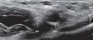 Echogram (B-mode) of the right femoral nerve in the transverse scanning plane at the level of the groin region (BN - femoral nerve, BA - femoral artery)