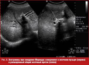 Echograms for Mirizzi syndrome