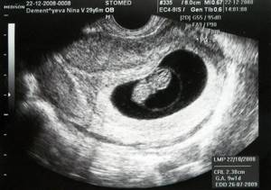 embryo at 7 weeks of pregnancy