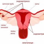 Endometriosis 1.jpg