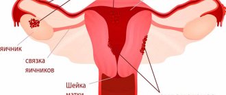 Endometriosis 1.jpg