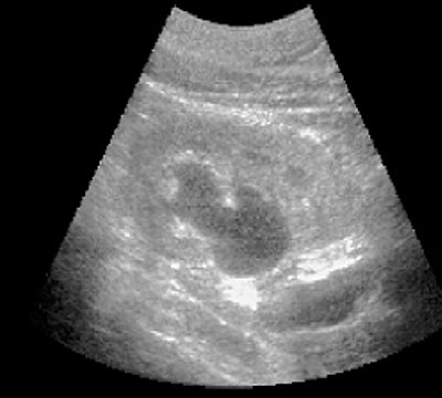 Pharmacoultrasonogram of the kidney with furosemide in case of impaired urine passage - 20 minutes after administration of the diuretic (b)