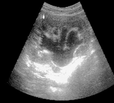 Pharmacoultrasonogram of the kidney with furosemide in case of impaired urine passage - 40 minutes after administration of the diuretic (c)
