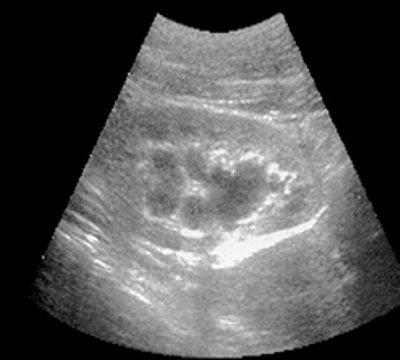 Pharmacoultrasonogram of the kidney with furosemide in case of impaired urine passage - initial data (a)