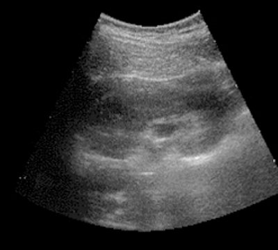 Pharmacoultrasonogram of the kidney with furosemide with undisturbed urine passage - 3 minutes after the administration of furosemide (b)