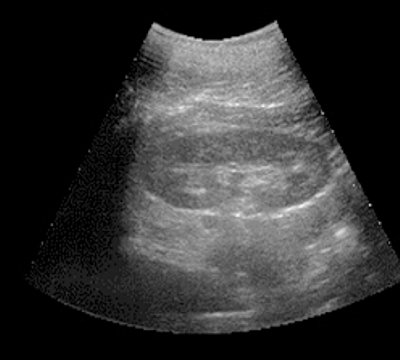 Pharmacoultrasonogram of the kidney with furosemide with undisturbed urine passage - 7 minutes after the administration of furosemide (c)